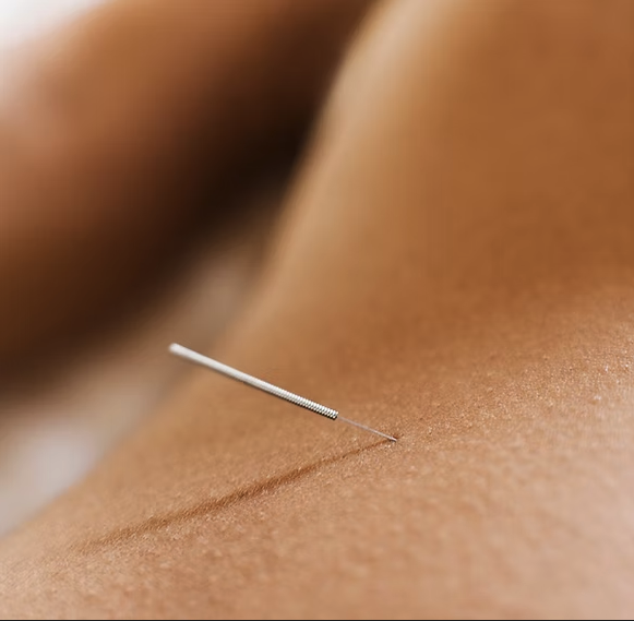 Dry needling — ponction sèche